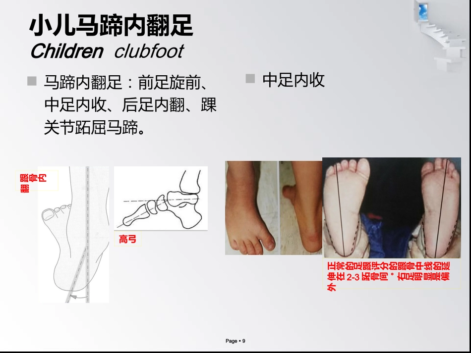 小儿马蹄内翻足_第9页