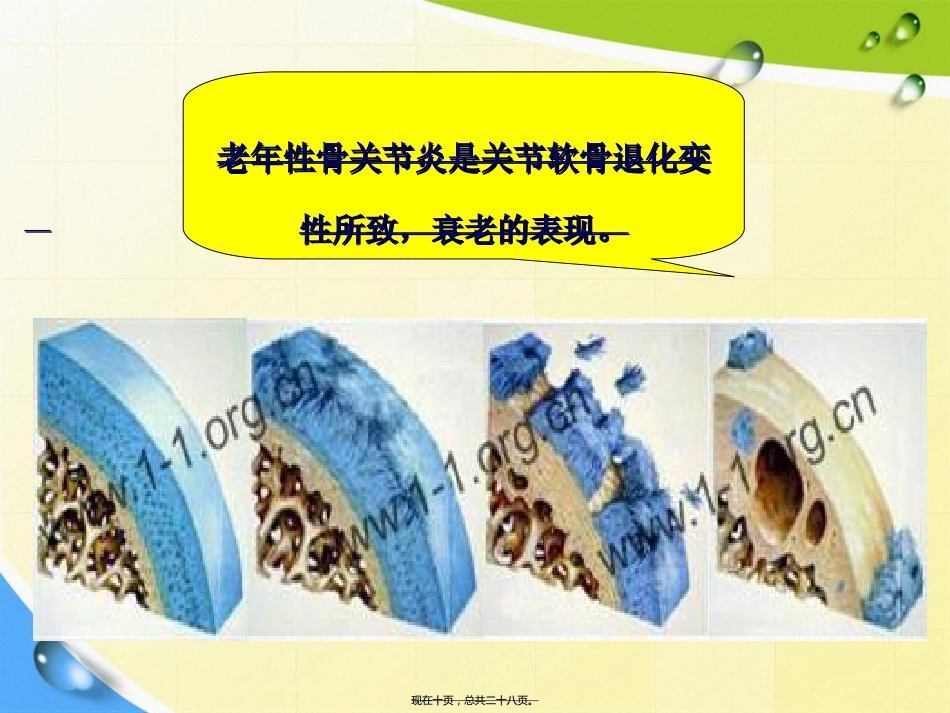 老人骨性关节炎诊疗患教讲课文档_第10页
