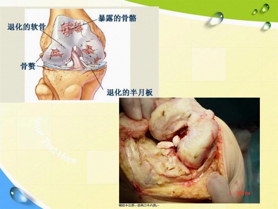 老人骨性关节炎诊疗患教讲课文档_第13页