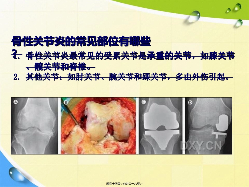 老人骨性关节炎诊疗患教讲课文档_第14页
