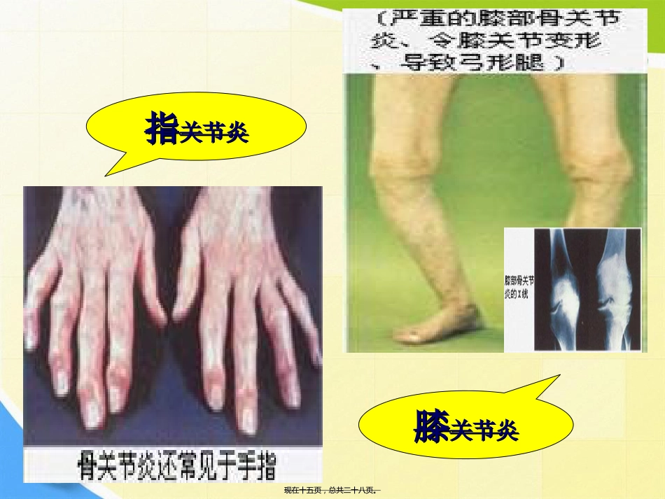 老人骨性关节炎诊疗患教讲课文档_第15页