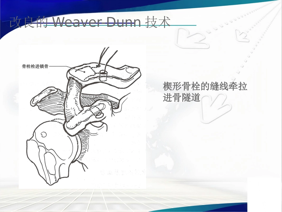 双ENDOBUTTON技术重建肩锁关节_第11页