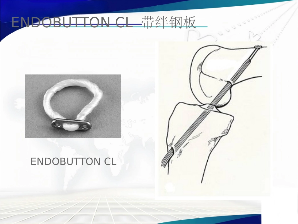 双ENDOBUTTON技术重建肩锁关节_第13页