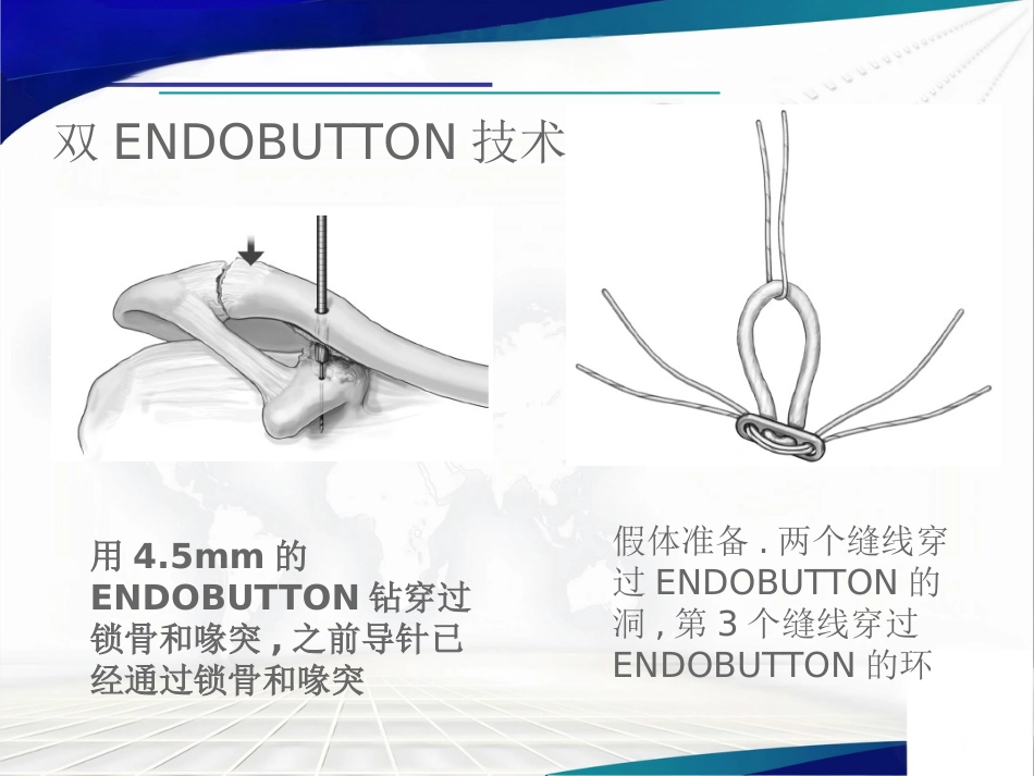 双ENDOBUTTON技术重建肩锁关节_第14页