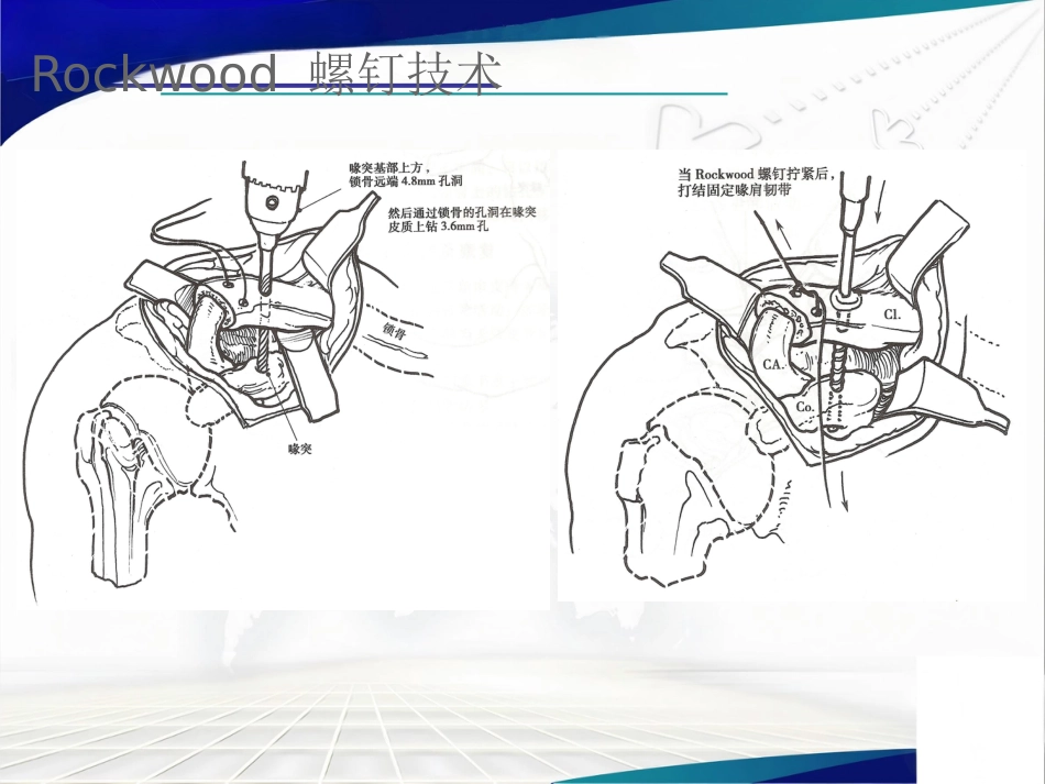 双ENDOBUTTON技术重建肩锁关节_第8页