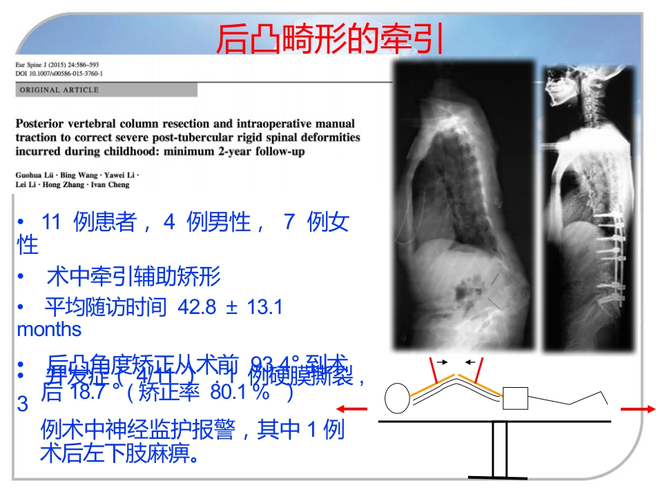 陈旧性结核后凸的手术治疗_第10页