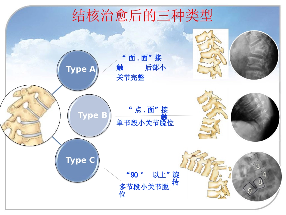 陈旧性结核后凸的手术治疗_第14页