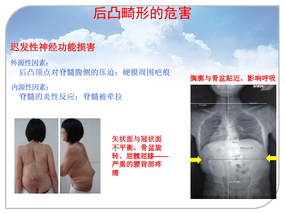 陈旧性结核后凸的手术治疗_第4页