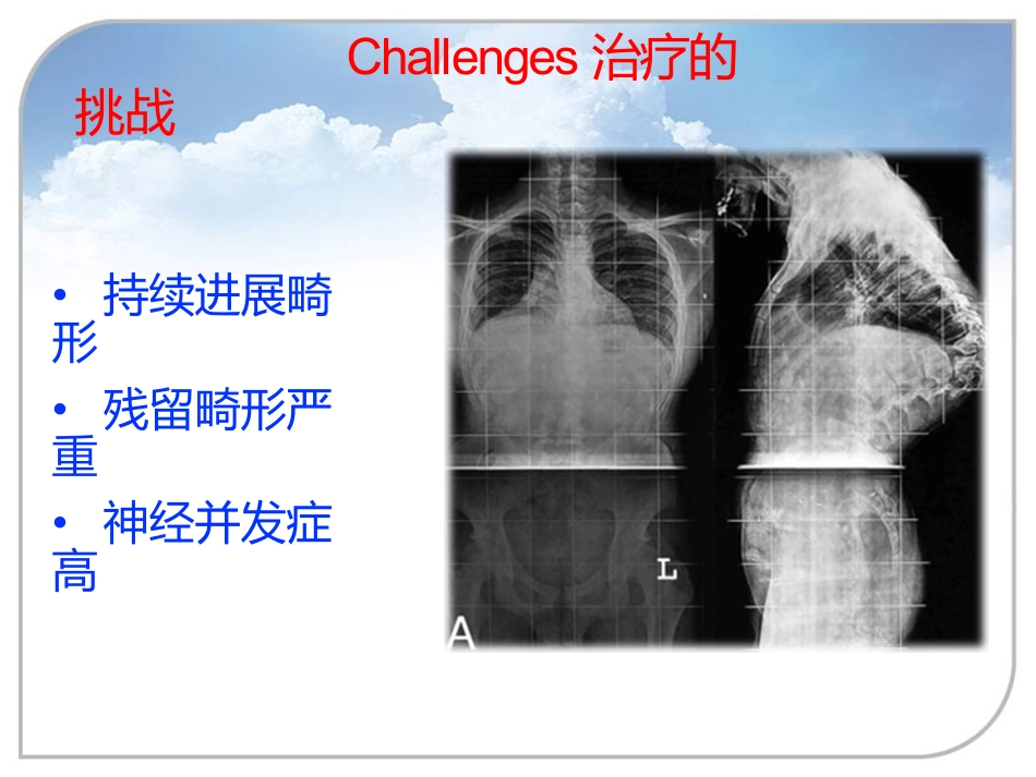 陈旧性结核后凸的手术治疗_第6页