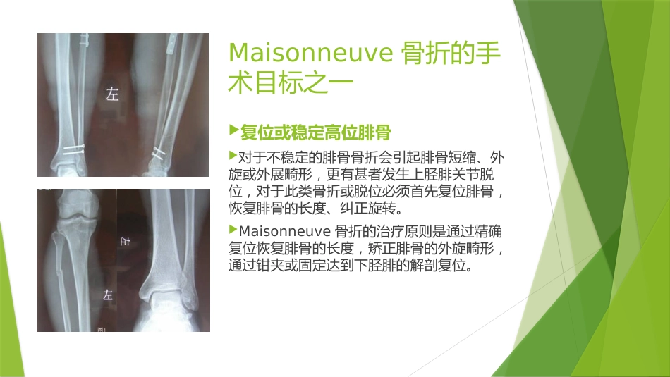特殊类型的踝关节骨折_第15页