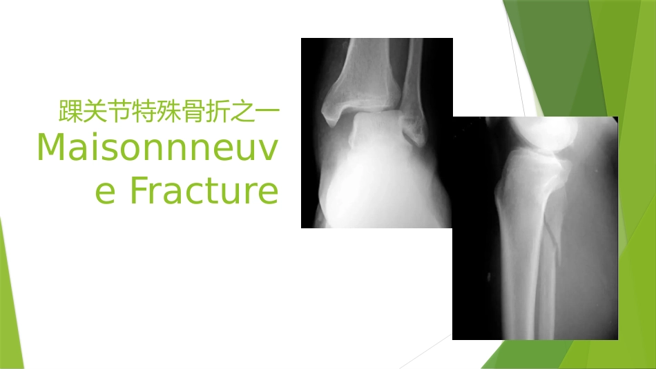 特殊类型的踝关节骨折_第3页