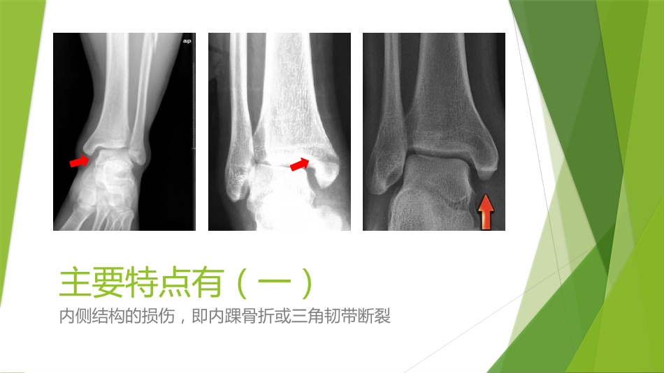 特殊类型的踝关节骨折_第7页