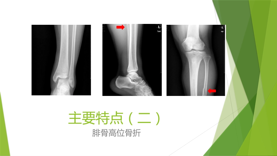 特殊类型的踝关节骨折_第8页