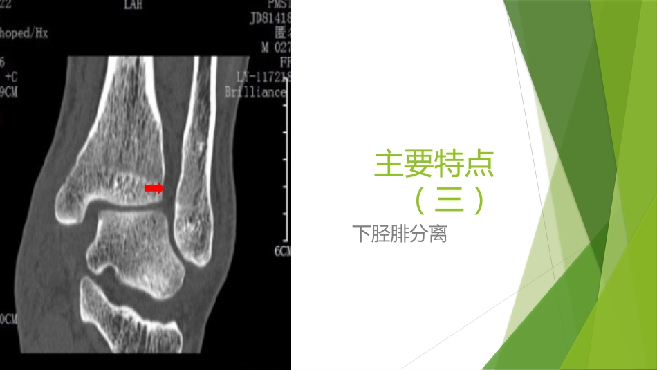 特殊类型的踝关节骨折_第9页