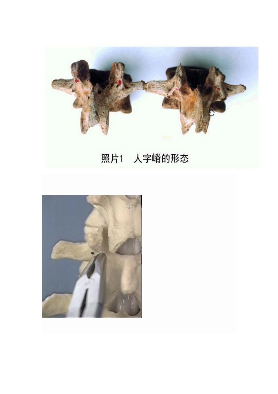 脊椎椎弓根钉进钉点的确定及手术技巧_第13页