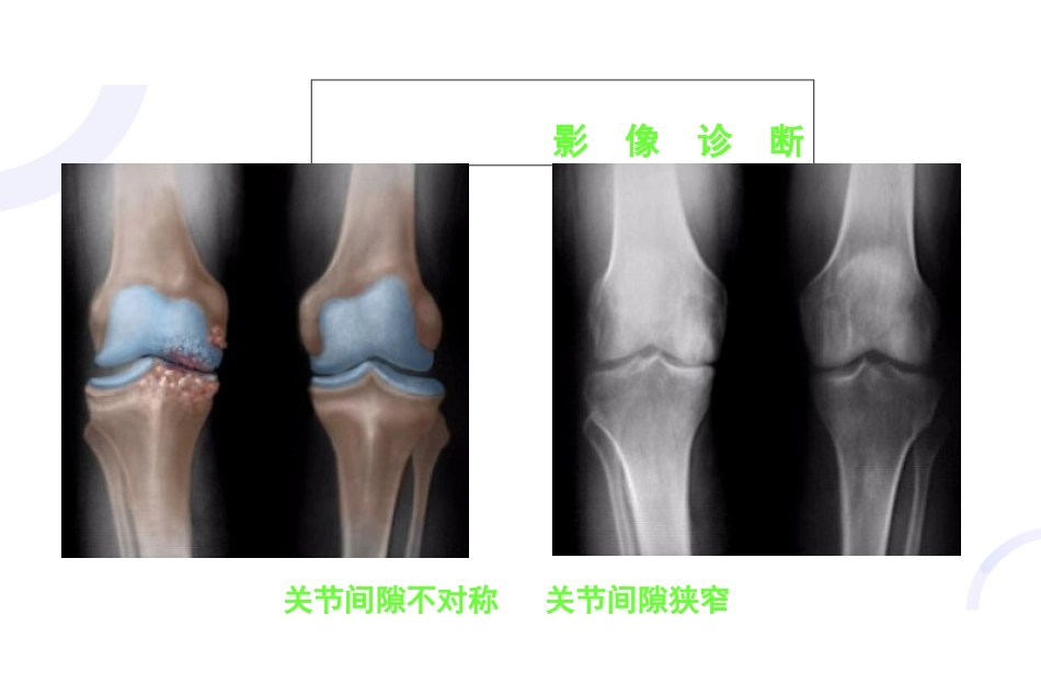 膝关节骨关节炎与人工全膝关节置换术_第11页