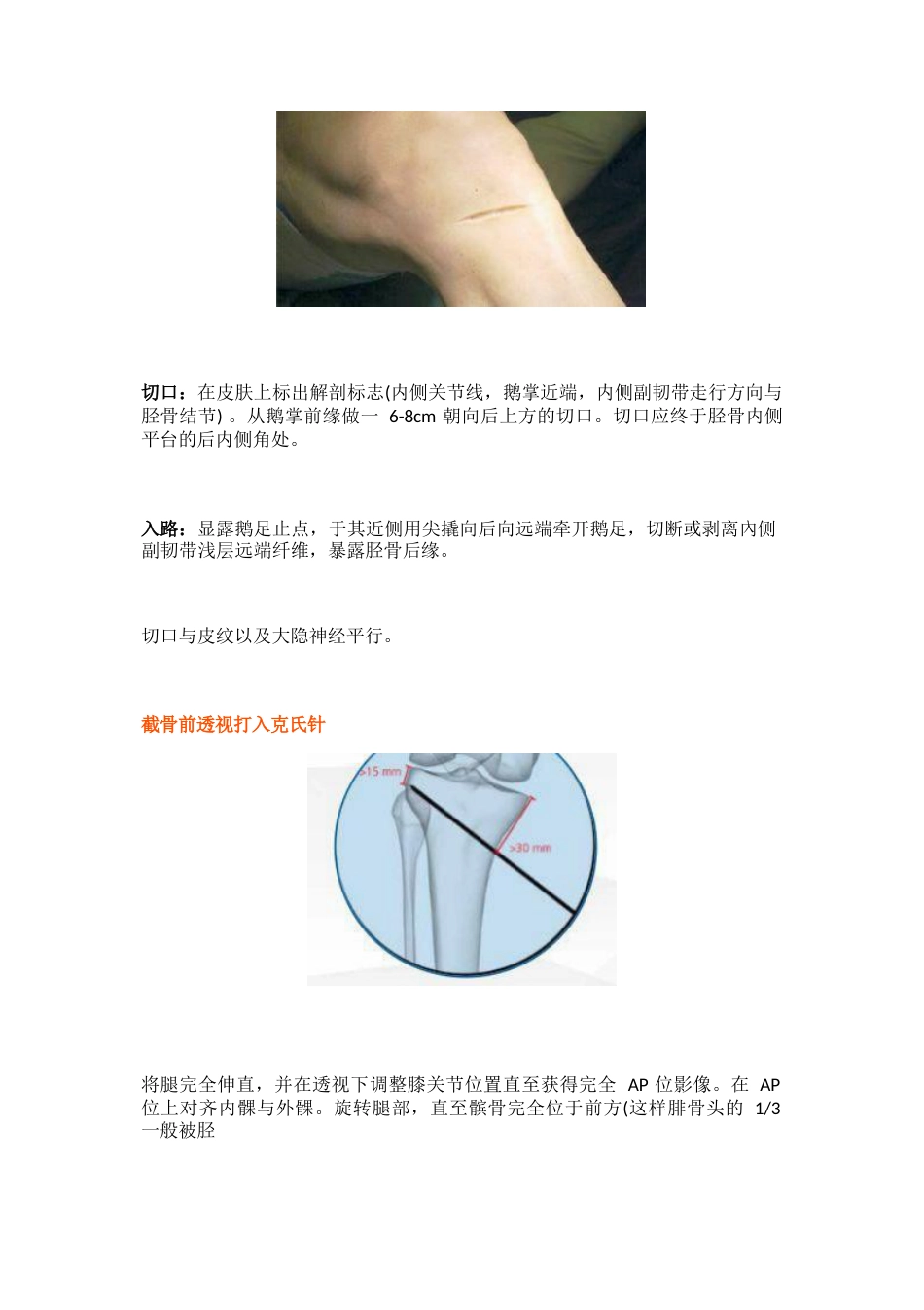 胫骨高位截骨术的手术步骤及技巧_第9页
