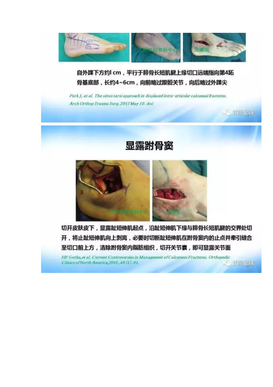 经跗骨窦切口治疗跟骨骨折_第10页