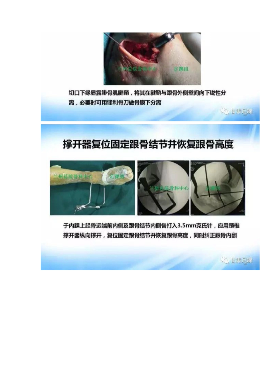 经跗骨窦切口治疗跟骨骨折_第11页
