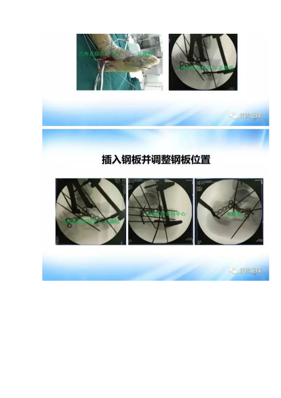 经跗骨窦切口治疗跟骨骨折_第12页