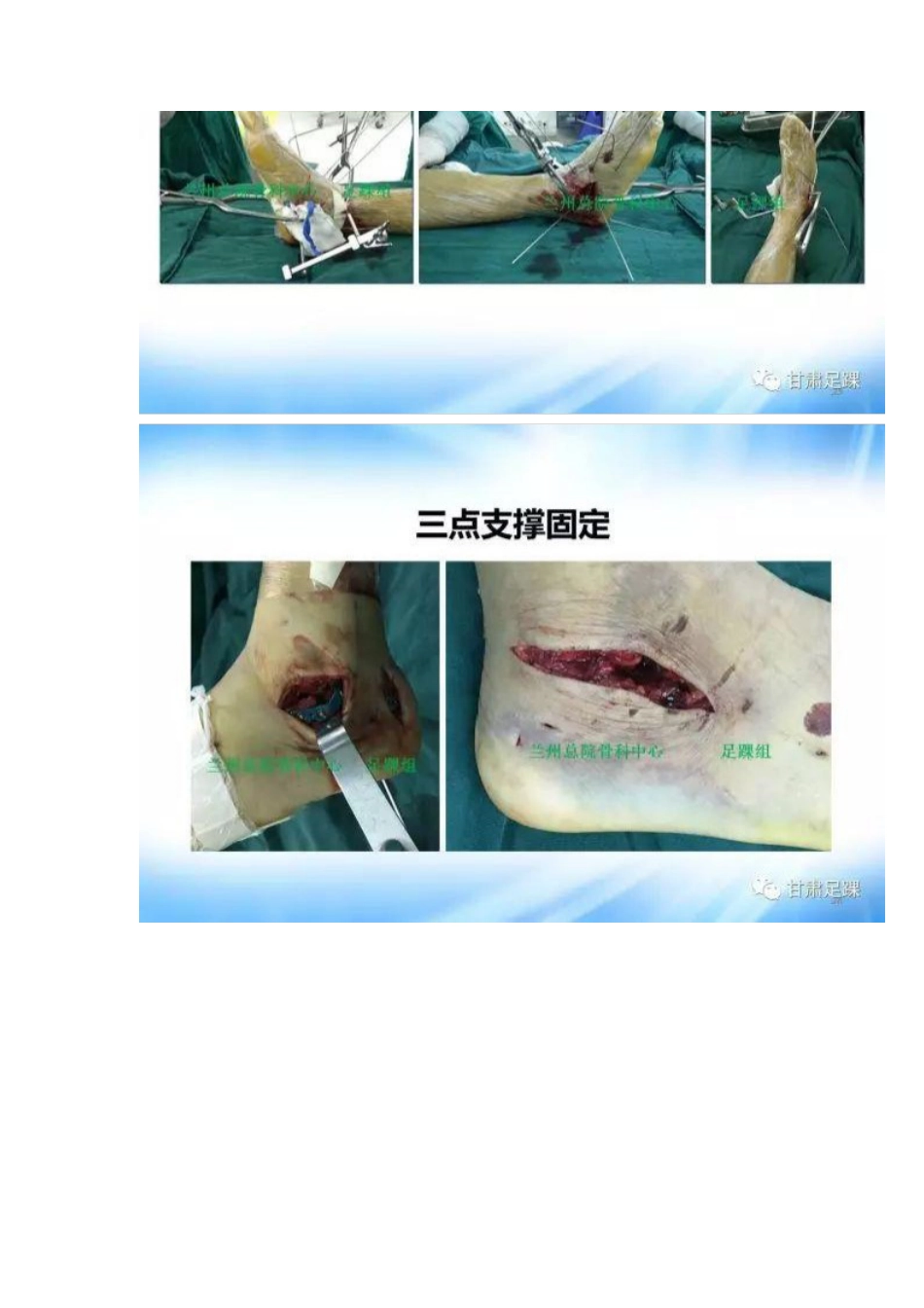 经跗骨窦切口治疗跟骨骨折_第13页