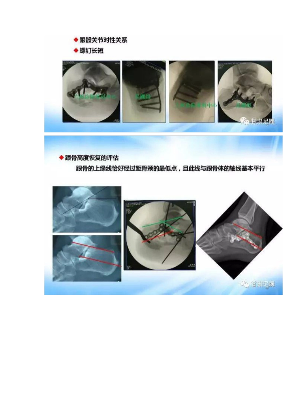 经跗骨窦切口治疗跟骨骨折_第14页