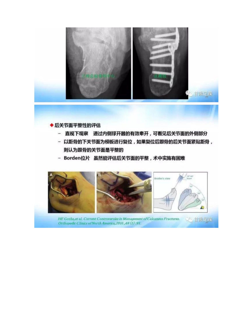 经跗骨窦切口治疗跟骨骨折_第15页