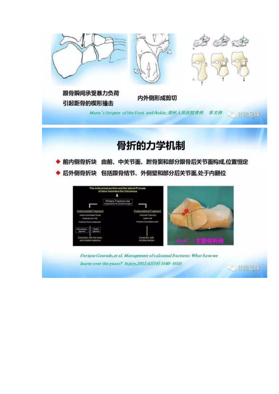 经跗骨窦切口治疗跟骨骨折_第3页