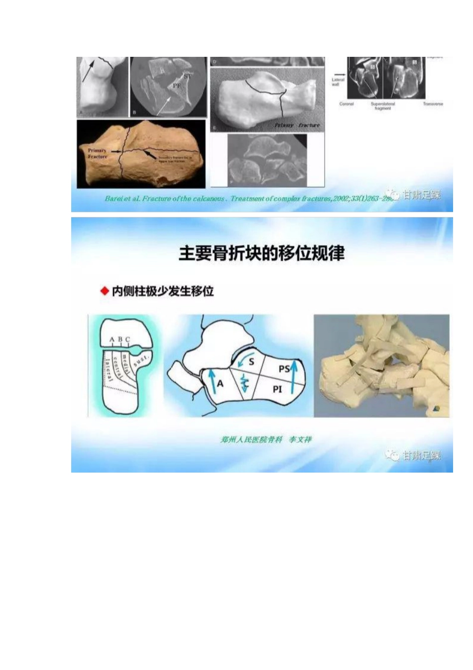 经跗骨窦切口治疗跟骨骨折_第4页