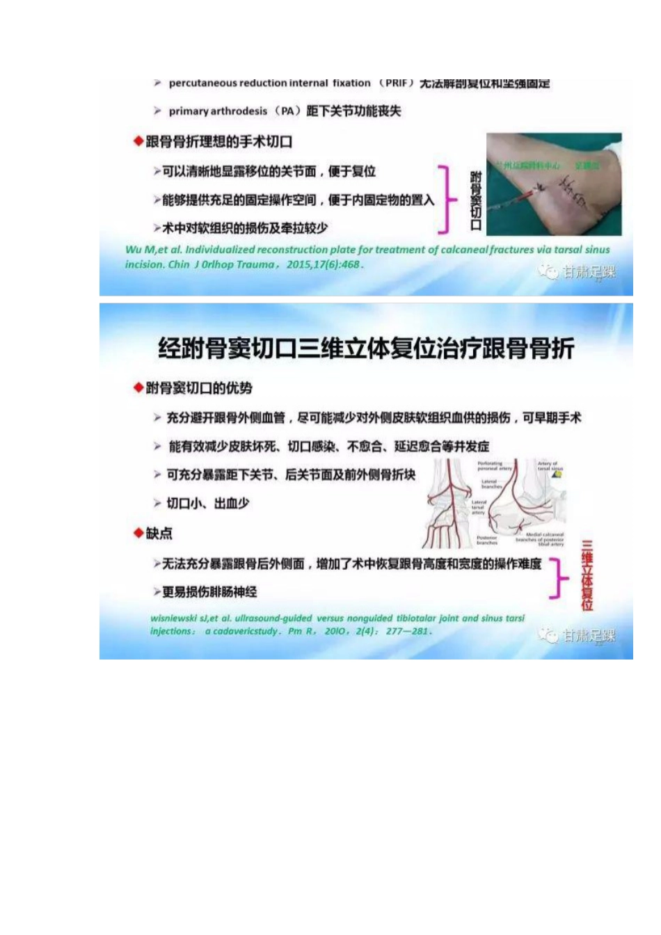 经跗骨窦切口治疗跟骨骨折_第6页
