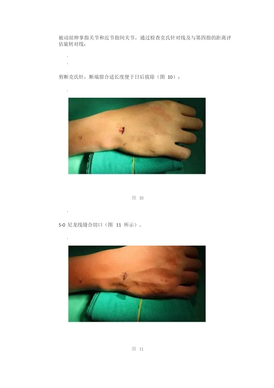 髓内针治疗移位性掌骨颈骨折技术_第10页