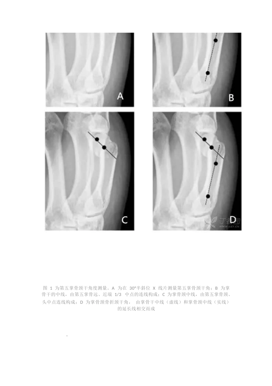 髓内针治疗移位性掌骨颈骨折技术_第2页
