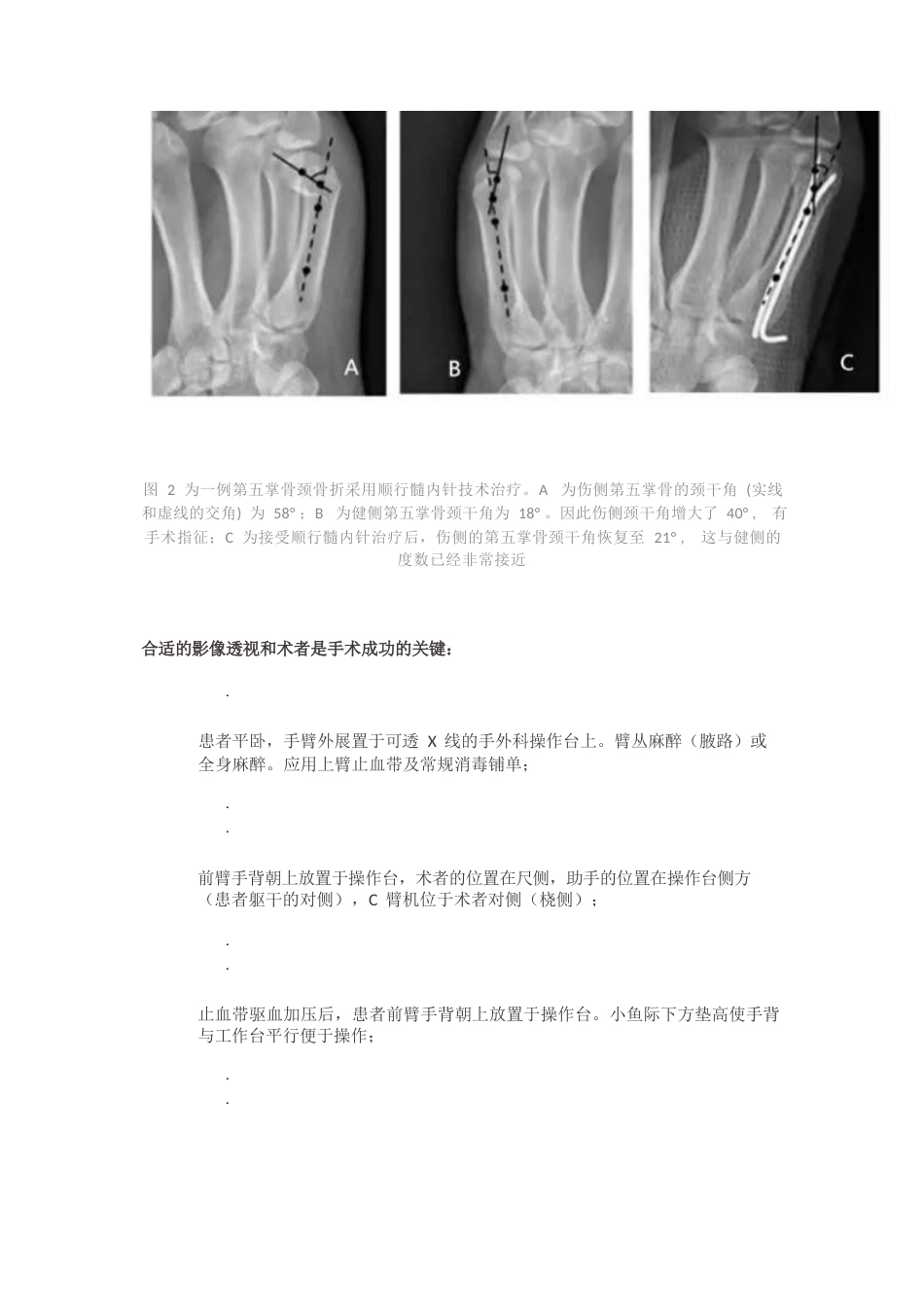 髓内针治疗移位性掌骨颈骨折技术_第4页