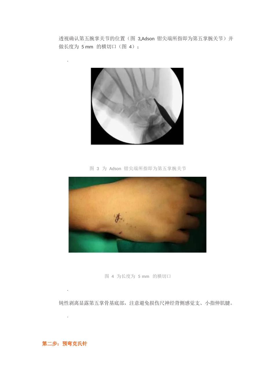 髓内针治疗移位性掌骨颈骨折技术_第5页