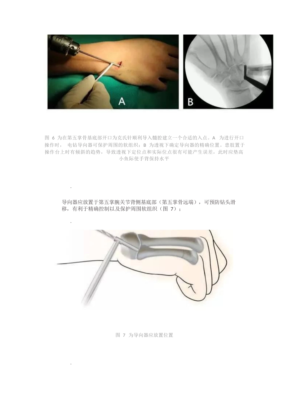 髓内针治疗移位性掌骨颈骨折技术_第7页