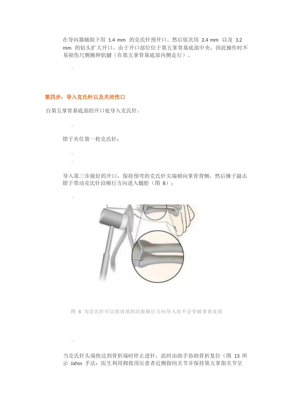 髓内针治疗移位性掌骨颈骨折技术_第8页