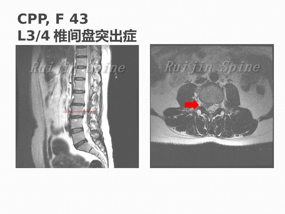 显微镜辅助手术治疗腰椎退行性疾病_第10页