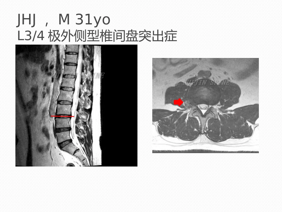 显微镜辅助手术治疗腰椎退行性疾病_第15页