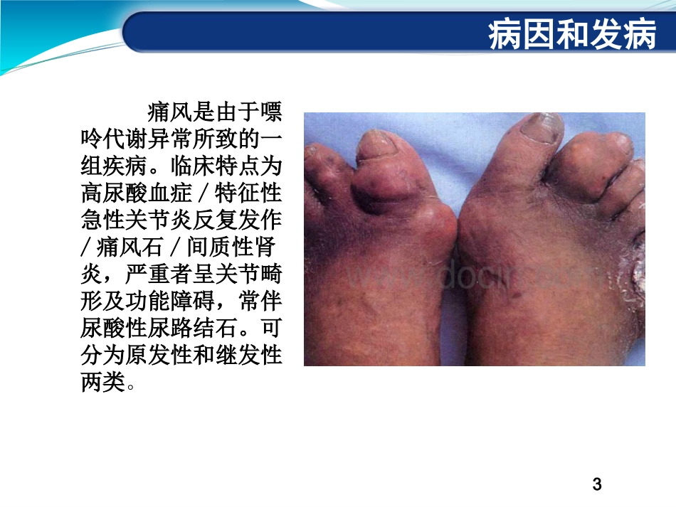 痛风性关节炎_第3页