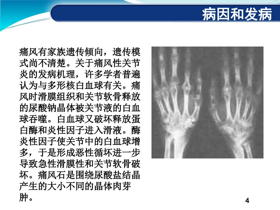 痛风性关节炎_第4页
