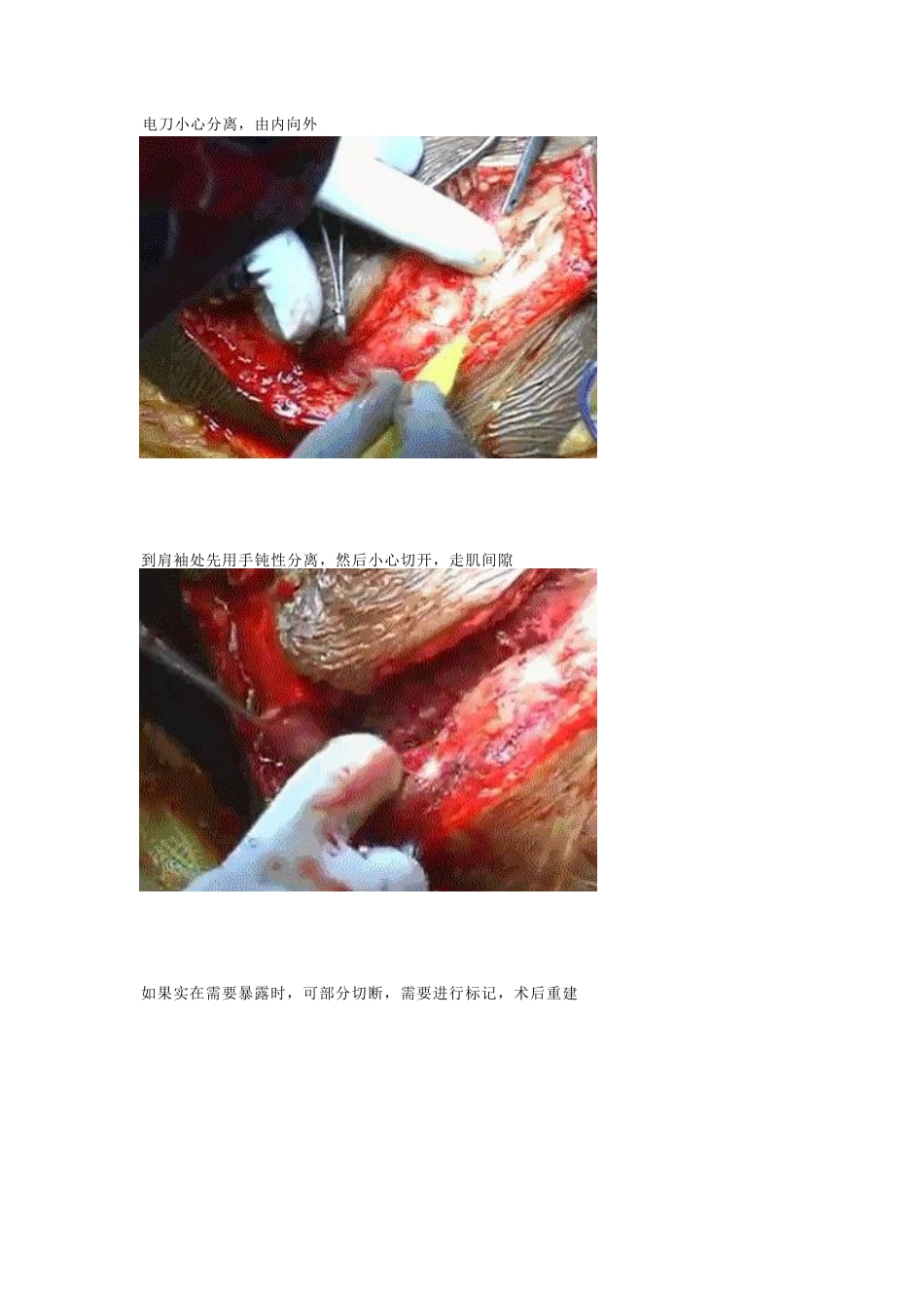 肩胛骨骨折的内固定手术技巧_第14页