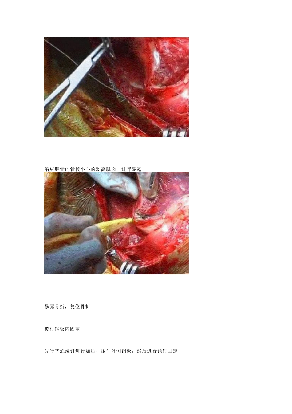 肩胛骨骨折的内固定手术技巧_第15页