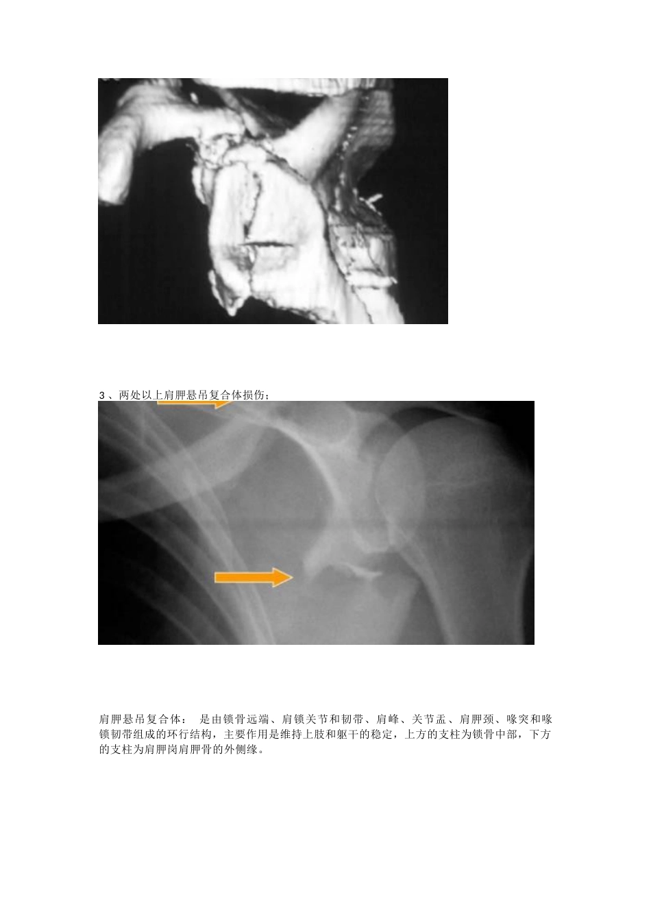 肩胛骨骨折的内固定手术技巧_第2页