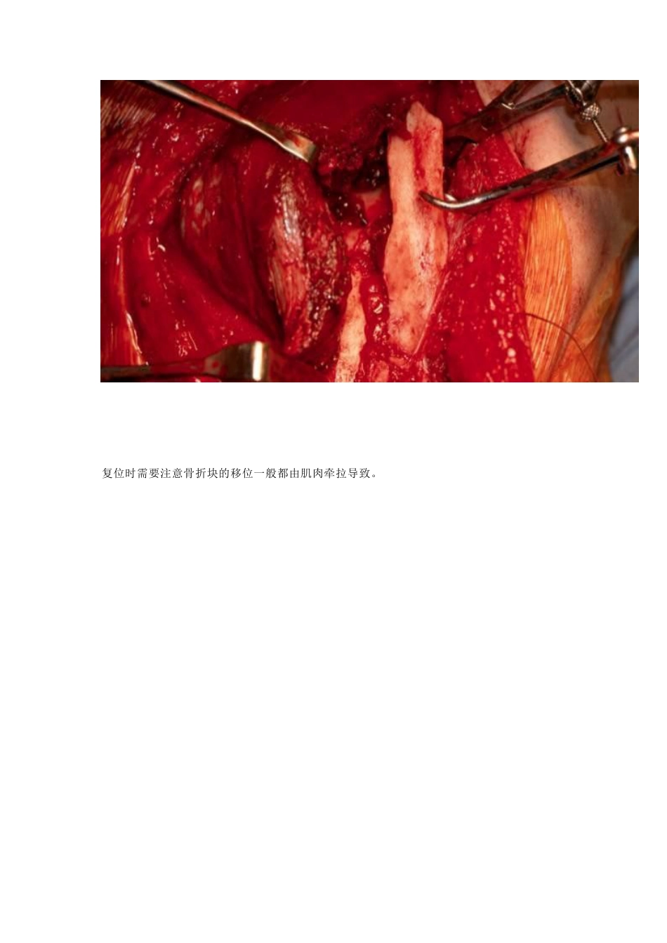 肩胛骨骨折的内固定手术技巧_第6页