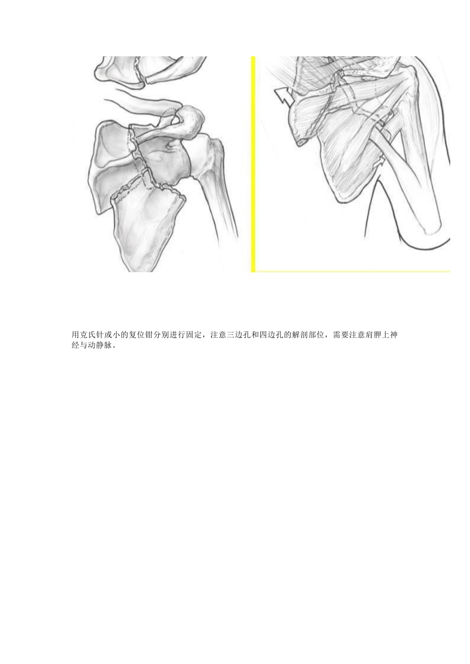 肩胛骨骨折的内固定手术技巧_第7页