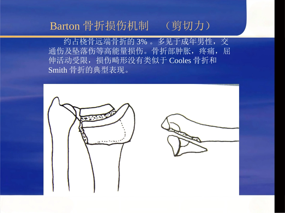 桡骨远端骨折治疗_第10页
