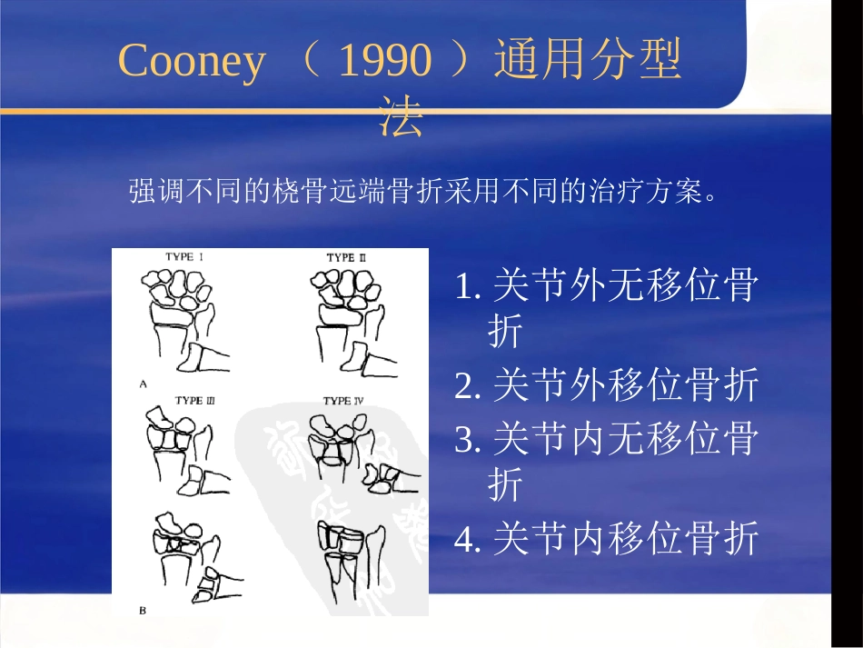 桡骨远端骨折治疗_第13页