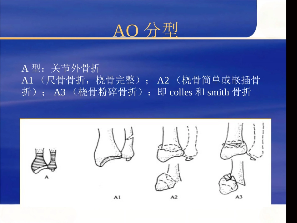 桡骨远端骨折治疗_第15页