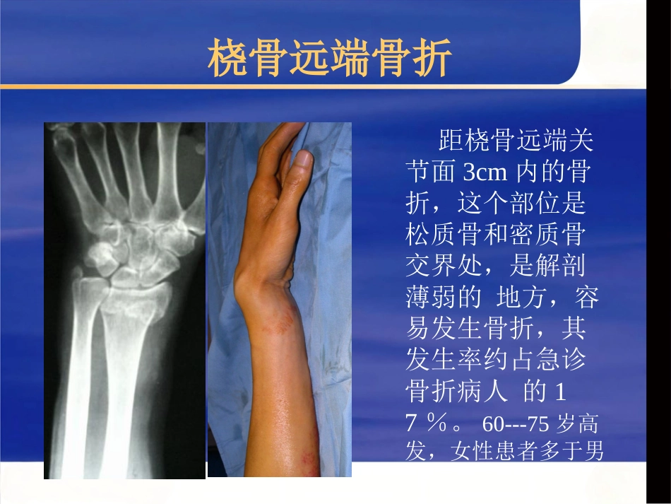 桡骨远端骨折治疗_第2页