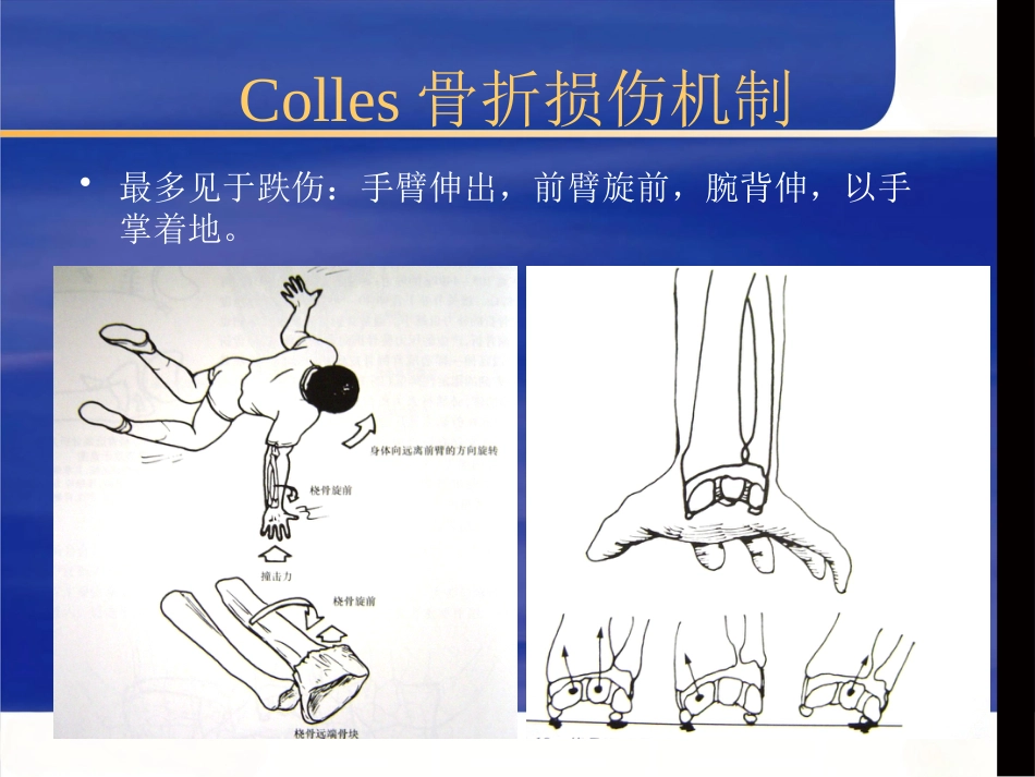 桡骨远端骨折治疗_第6页
